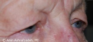 Image of patient before eyelid surgery, blepharoplasty
